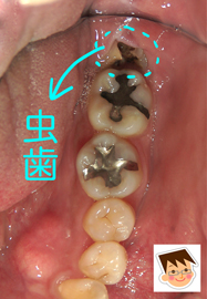 親知らずが歯茎の中で崩壊
