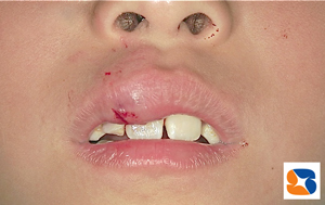 前歯をぶつけて唇も腫れる