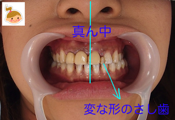 真ん中のズレ　変な形の歯