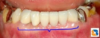 新しい前歯　ブリッジ　６連結