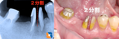 奥歯をメンテナンスしやすいように分割保存
