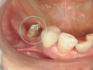 セラミック被せ