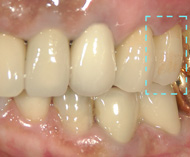 白いセラミック