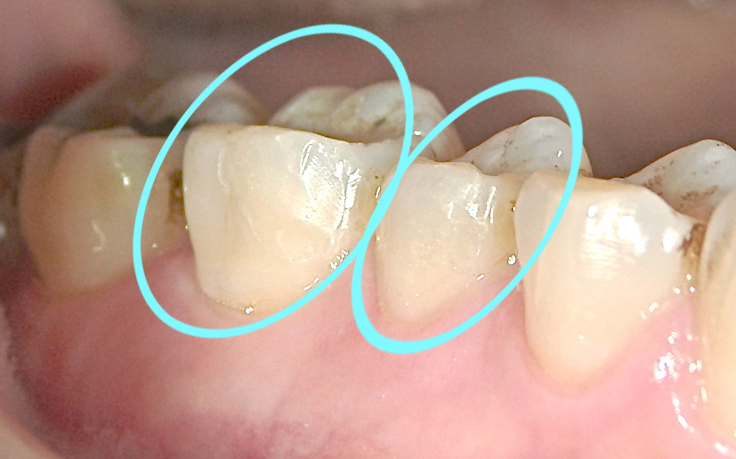 応急処置／レジン充填／神経