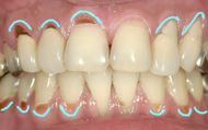 レジン／前歯