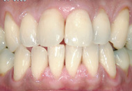 短時間で白い歯