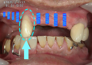 インプラントのために抜歯する？