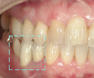 審美セラミック
