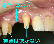 慎重に削って神経を残す