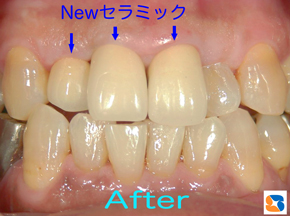 自然な感じのセラミック歯