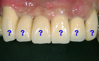 術後：長持ちする治療を心掛けています