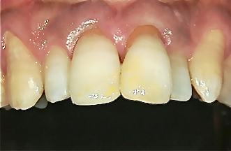 １日で修復とヤニ取り