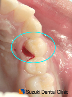 歯が割れた　神経　痛む