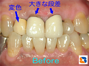 いろいろと問題のあったさし歯