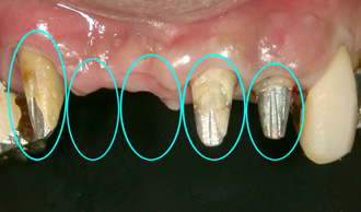 術前：入れ歯から固定のブリッジにチェンジ