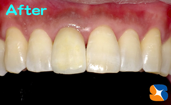 ドクターが一から作るオールセラミック