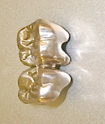 いつでも取り外し可能な被せ物の歯