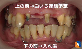 下に入れ歯を装着