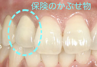 保険適用　前歯　かぶせ物