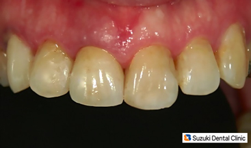 セラミックの前歯