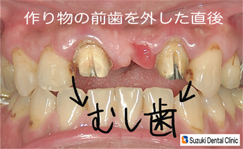 前歯が１本ないため３連結が入っていた