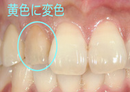 前歯の変色