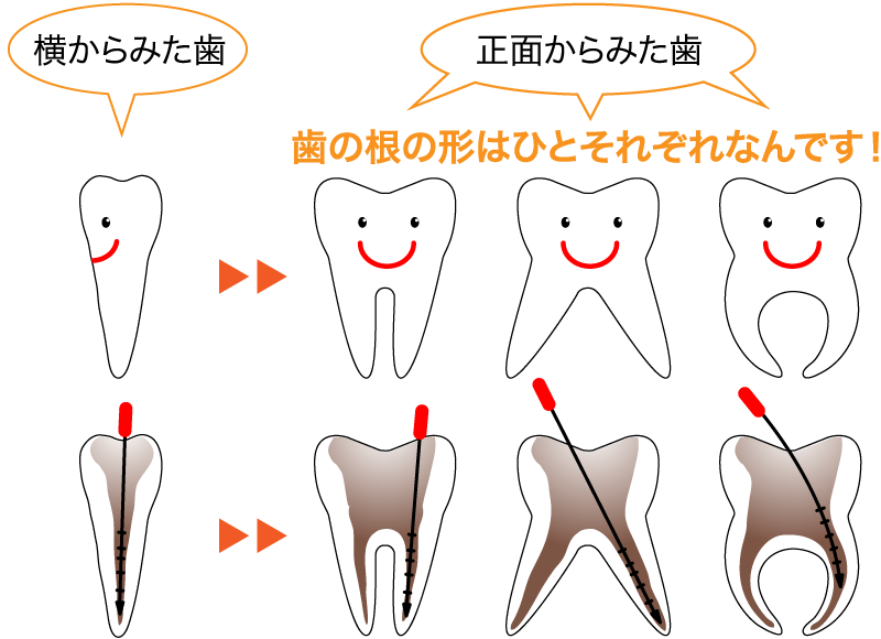 歯の根の形はひとそれぞれなんです！