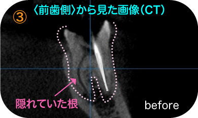 前歯側から見た画像・before（CT）