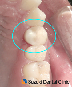 オールセラミック　神経　守る