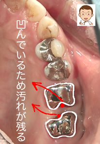 歯間ブラシでも難所：上の奥歯