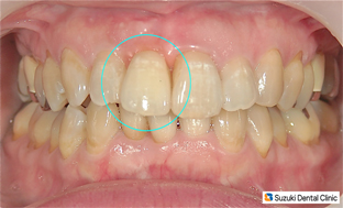 インプラントと矯正が完成
