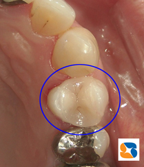 オールセラミックの白い詰め物