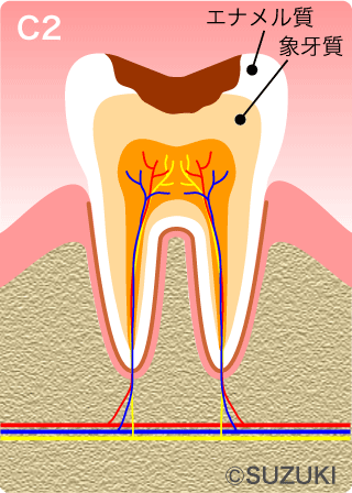 C2.：象牙質の虫歯