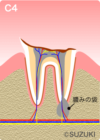 C4：歯根まで進んだ虫歯
