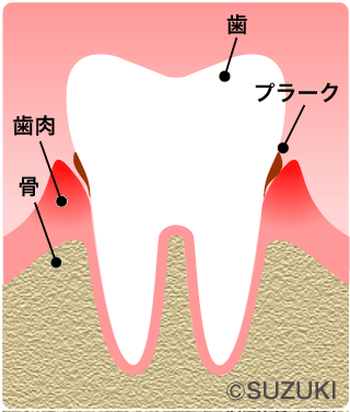P1：歯肉炎～歯周病の間