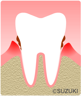 P2.：軽度の歯周病