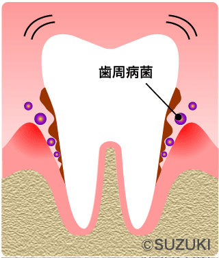 P3：中度の歯周病