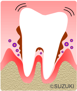 P4：重度の歯周病