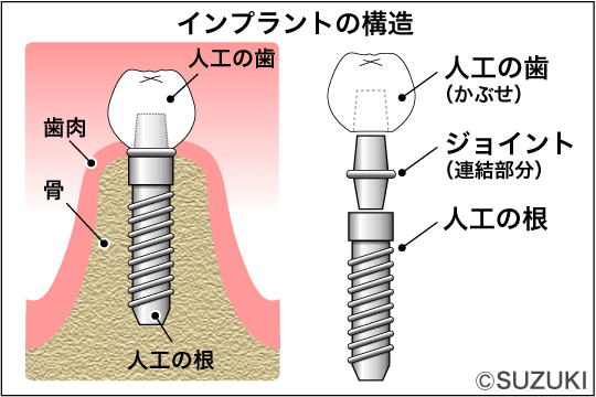 インプラントの構造