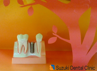 石切　インプラント　安心