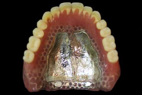 極薄のメタルプレート：総入れ歯