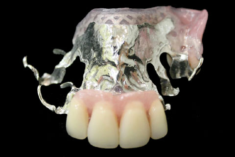極薄のメタルプレート：部分入れ歯