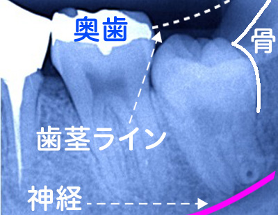 抜歯前のレントゲン