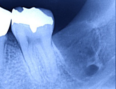 抜歯後のレントゲン