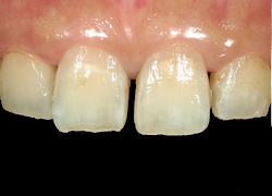 歯と歯の間の黄ばみ