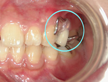唇で隠れる目立たない入れ歯