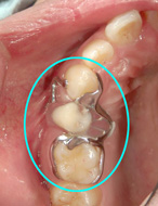 ミニ入れ歯を装着したところ