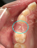 生まれつき歯がない